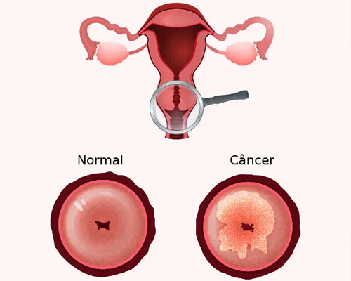 Câncer de colo de útero: sintomas, causas e tratamento